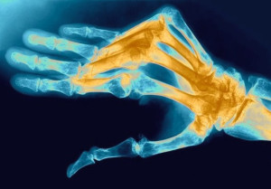artrit-palcev-ruk-1