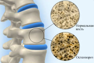 prichini-osteoporoza