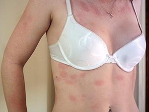 allergija-na-lekarstva
